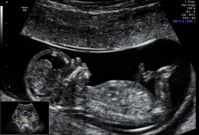 Снимок УЗИ при беременности