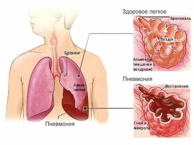 Признаки пневмонии