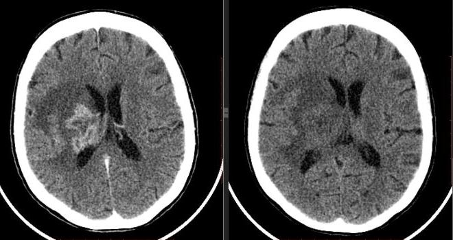 Снимок КТ головного мозга