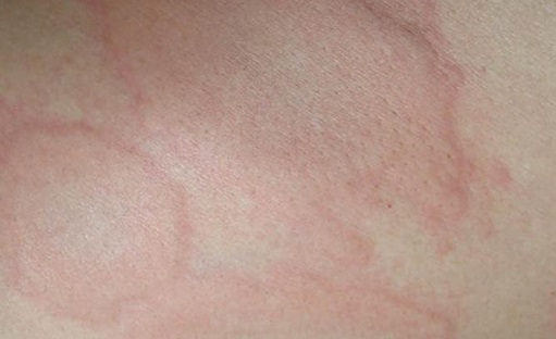 Аллергия на солнце: симптомы (фото), лечение и профилактика