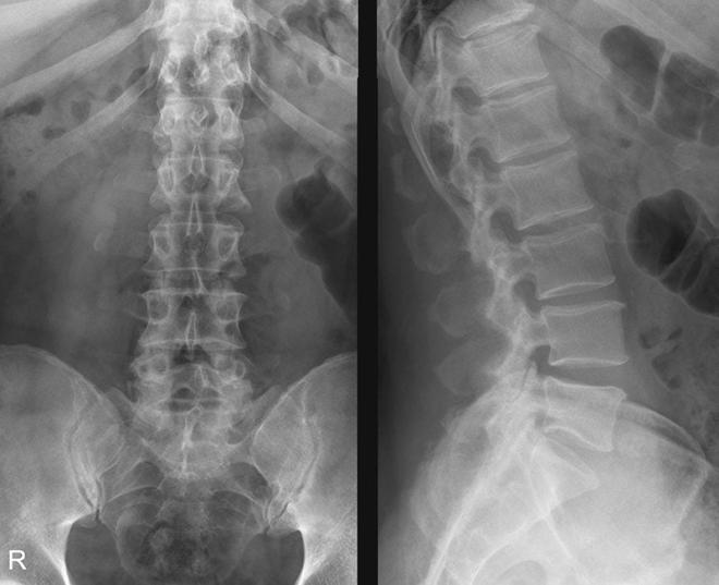 Рентгеновский снимок пояснично-крестцового отдела позвоночника