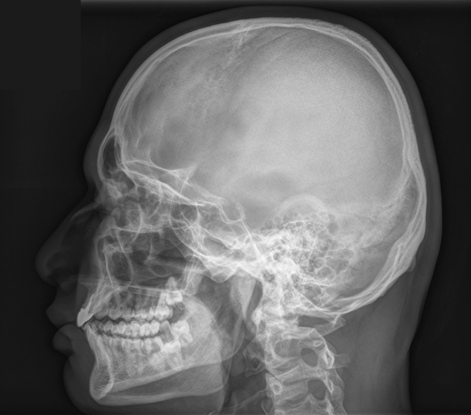 Рентгеновский снимок черепа
