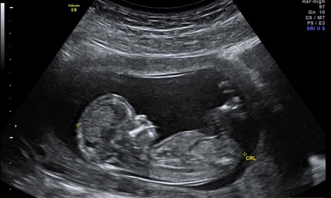 Снимок УЗИ на 14 неделе беременности
