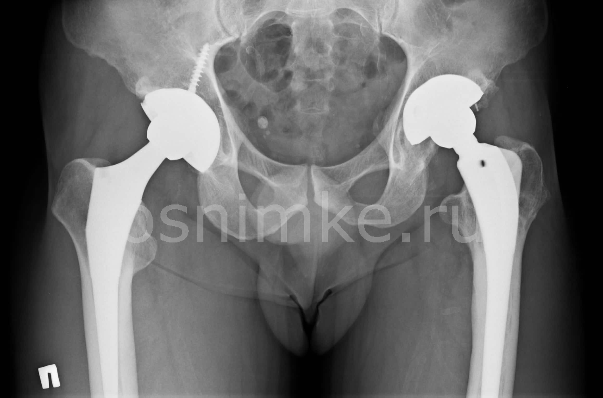 Рентген тазобедренного сустава в двух проекциях фото