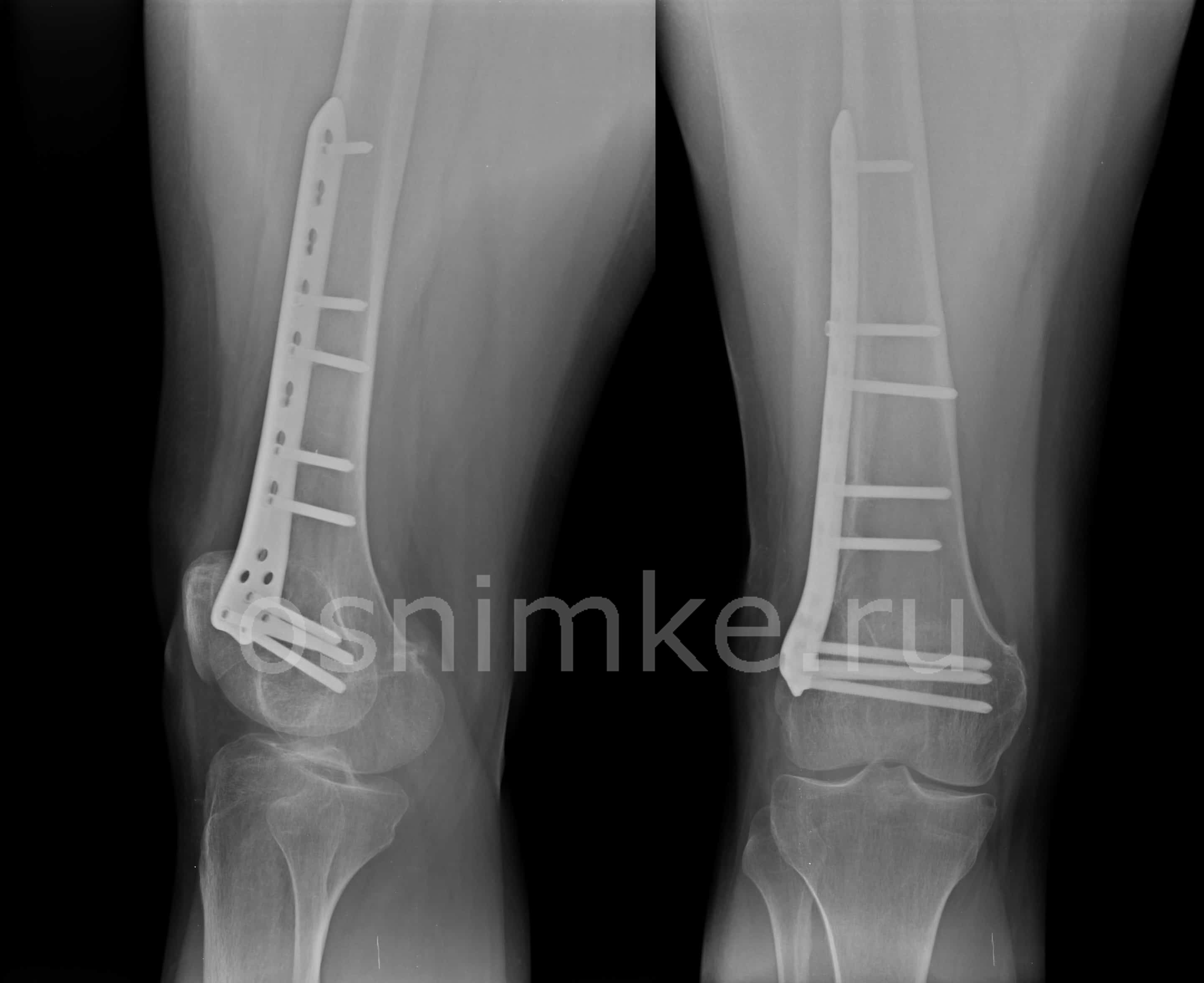Панорамная рентгенография ног
